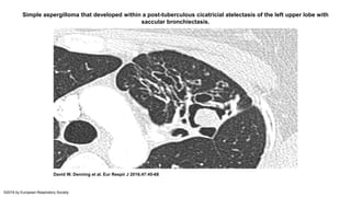 Simple aspergilloma that developed within a post-tuberculous cicatricial atelectasis of the left upper lobe with
saccular bronchiectasis.
David W. Denning et al. Eur Respir J 2016;47:45-68
©2016 by European Respiratory Society
 
