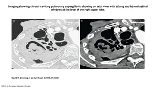 Imaging showing chronic cavitary pulmonary aspergillosis showing an axial view with a) lung and b) mediastinal
windows at the level of the right upper lobe.
David W. Denning et al. Eur Respir J 2016;47:45-68
©2016 by European Respiratory Society
 