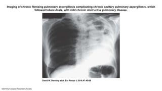 Imaging of chronic fibrosing pulmonary aspergillosis complicating chronic cavitary pulmonary aspergillosis, which
followed tuberculosis, with mild chronic obstructive pulmonary disease.
David W. Denning et al. Eur Respir J 2016;47:45-68
©2016 by European Respiratory Society
 