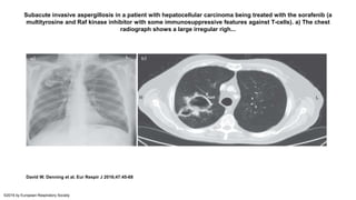 Subacute invasive aspergillosis in a patient with hepatocellular carcinoma being treated with the sorafenib (a
multityrosine and Raf kinase inhibitor with some immunosuppressive features against T-cells). a) The chest
radiograph shows a large irregular righ...
David W. Denning et al. Eur Respir J 2016;47:45-68
©2016 by European Respiratory Society
 
