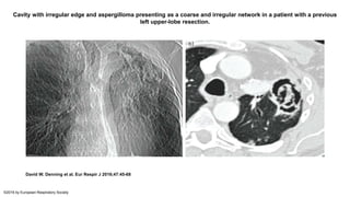 Cavity with irregular edge and aspergilloma presenting as a coarse and irregular network in a patient with a previous
left upper-lobe resection.
David W. Denning et al. Eur Respir J 2016;47:45-68
©2016 by European Respiratory Society
 