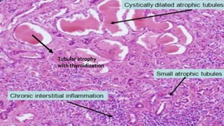 Tubular atrophy
with thyroidization
 