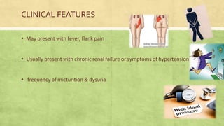 CLINICAL FEATURES
▪ May present with fever, flank pain
▪ Usually present with chronic renal failure or symptoms of hypertension
▪ frequency of micturition & dysuria
 