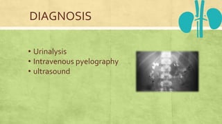 DIAGNOSIS
• Urinalysis
• Intravenous pyelography
• ultrasound
 