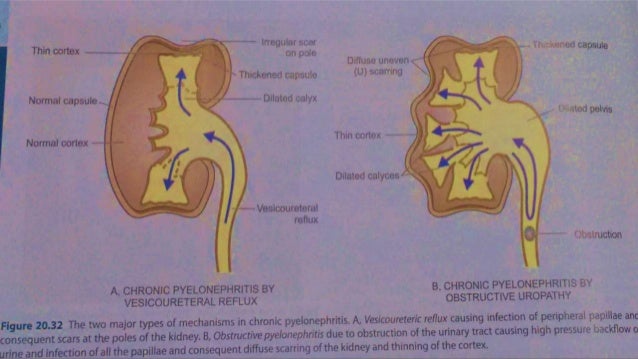 Chronic pyelonephritis urine formation diagram 