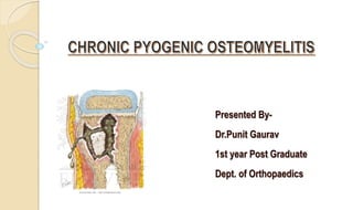 Presented By-
Dr.Punit Gaurav
1st year Post Graduate
Dept. of Orthopaedics
 