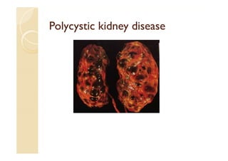 Polycystic kidney diseasePolycystic kidney diseasePolycystic kidney diseasePolycystic kidney disease
 