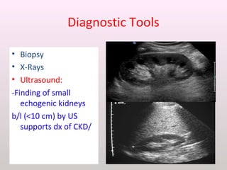 Diagnostic Tools
• Biopsy
• X-Rays
• Ultrasound:
-Finding of small
echogenic kidneys
b/l (<10 cm) by US
supports dx of CKD/
 
