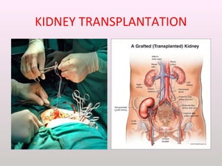 KIDNEY TRANSPLANTATION
 