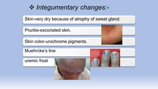 Integumentary changes:-
Skin-very dry because of atrophy of sweat gland.
Pruritis-excoriated skin.
Skin color-urochrome pigments.
Muehrcke’s line
uremic frost
 