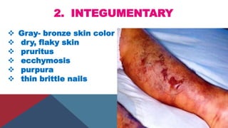2. INTEGUMENTARY
 Gray- bronze skin color
 dry, flaky skin
 pruritus
 ecchymosis
 purpura
 thin brittle nails
 