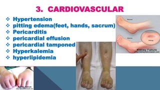 3. CARDIOVASCULAR
 Hypertension
 pitting edema(feet, hands, sacrum)
 Pericarditis
 pericardial effusion
 pericardial tamponed
 Hyperkalemia
 hyperlipidemia
 