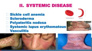 II. SYSTEMIC DISEASE
Sickle cell anemia
Scleroderma
Polyateritis nodosa
Systemic lupus erythematous
Vasculitis
 