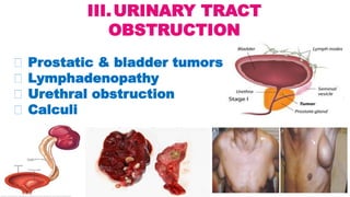 III.URINARY TRACT
OBSTRUCTION
Prostatic & bladder tumors
Lymphadenopathy
Urethral obstruction
Calculi
 