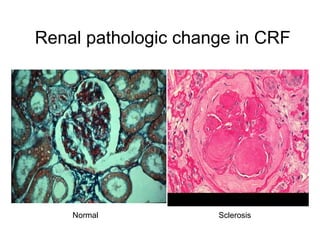 Renal pathologic change in CRF Normal Sclerosis 