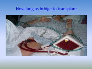Novalung as bridge to transplant
 
