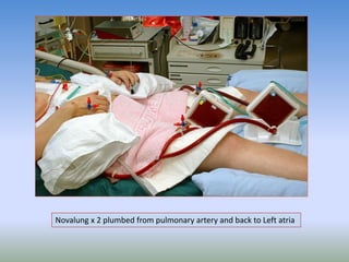 Novalung x 2 plumbed from pulmonary artery and back to Left atria
 
