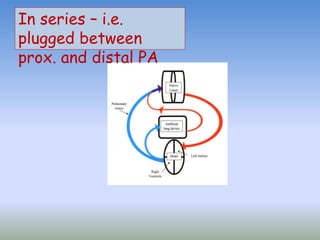 In series – i.e.
plugged between
prox. and distal PA
 