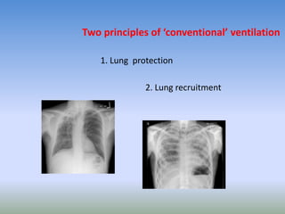 Two principles of ‘conventional’ ventilation
1. Lung protection
2. Lung recruitment
 
