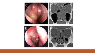 Chronic Rhinosinusitis & management .pptx