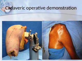 Cadaveric operative demonstration
 