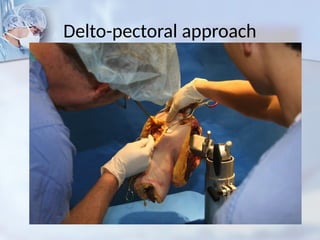 Delto-pectoral approach
 