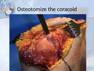 Osteotomize the coracoid
 