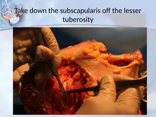 Take down the subscapularis off the lesser
tuberosity
 