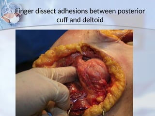 Finger dissect adhesions between posterior
cuff and deltoid
 