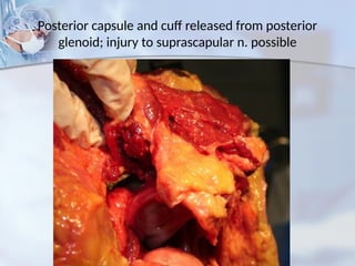 Posterior capsule and cuff released from posterior
glenoid; injury to suprascapular n. possible
 