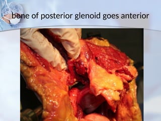 bone of posterior glenoid goes anterior
 