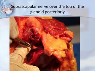 Suprascapular nerve over the top of the
glenoid posteriorly
 
