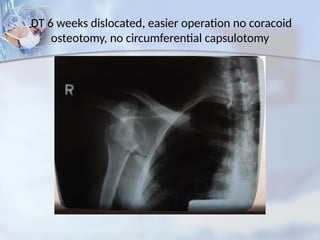 DT 6 weeks dislocated, easier operation no coracoid
osteotomy, no circumferential capsulotomy
 