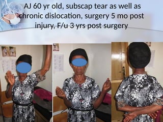 AJ 60 yr old, subscap tear as well as
chronic dislocation, surgery 5 mo post
injury, F/u 3 yrs post surgery
 