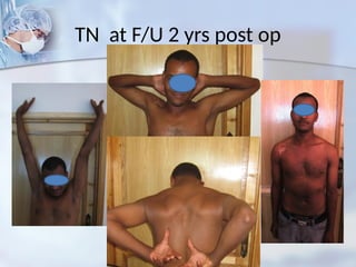 TN at F/U 2 yrs post op
 