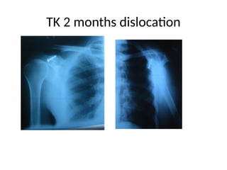 TK 2 months dislocation
 