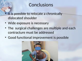Conclusions
• It is possible to relocate a chronically
dislocated shoulder
• Wide exposure is necessary
• The surgical challenges are multiple and each
contracture must be addressed
• Good functional improvement is possible
 