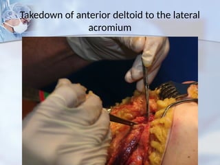 Takedown of anterior deltoid to the lateral
acromium
 