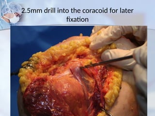 2.5mm drill into the coracoid for later
fixation
 