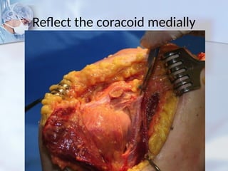 Reflect the coracoid medially
 