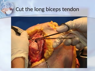 Cut the long biceps tendon
 
