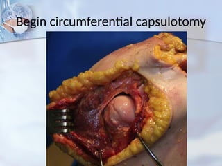 Begin circumferential capsulotomy
 