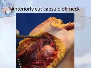 Anteriorly cut capsule off neck
 