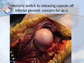 Inferiorly switch to releasing capsule off
inferior glenoid: concern for ax n.
 