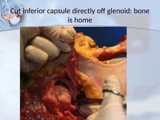 Cut inferior capsule directly off glenoid: bone
is home
 