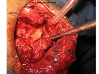 Real surgery, left shoulder
anterior
head
deltoid
 