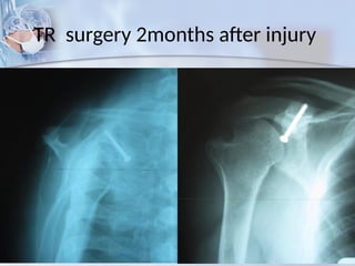 TR surgery 2months after injury
 