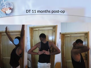 DT 11 months post-op
 