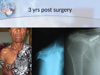 3 yrs post surgery
 