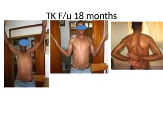 TK F/u 18 months
 